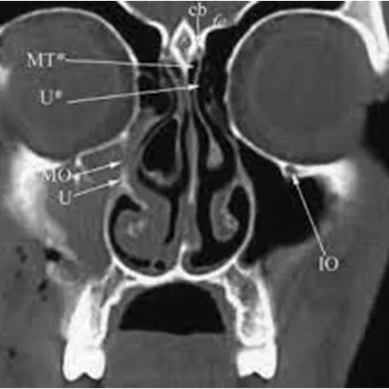 CECT PNS (Para-Nasal Sinus) Axial